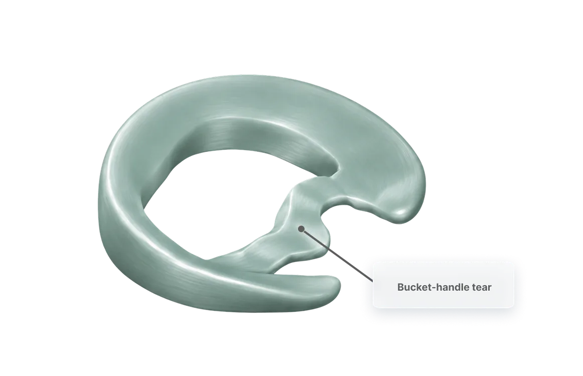 Diagram of a meniscus with a bucket-handle tear, where the loosened fragment has flipped into the middle of the joint