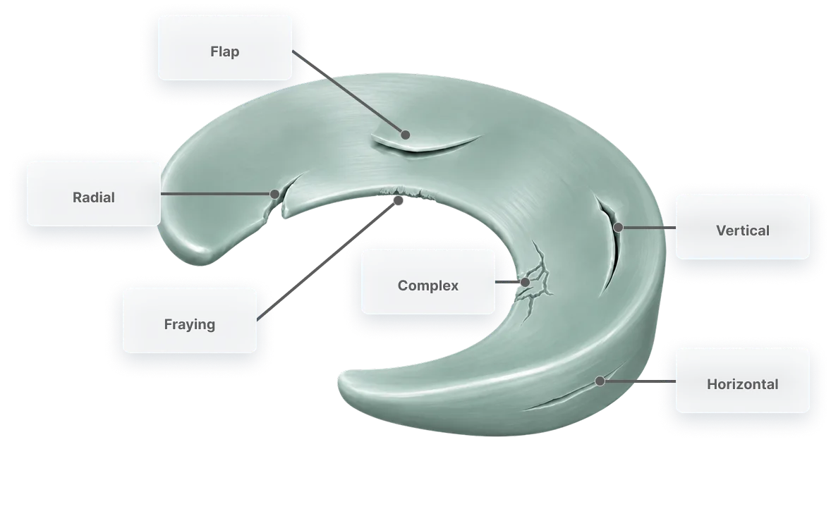 Diagram of a C-shaped meniscus showing common tear patterns labelled: flap, radial, fraying, complex, vertical and horizontal