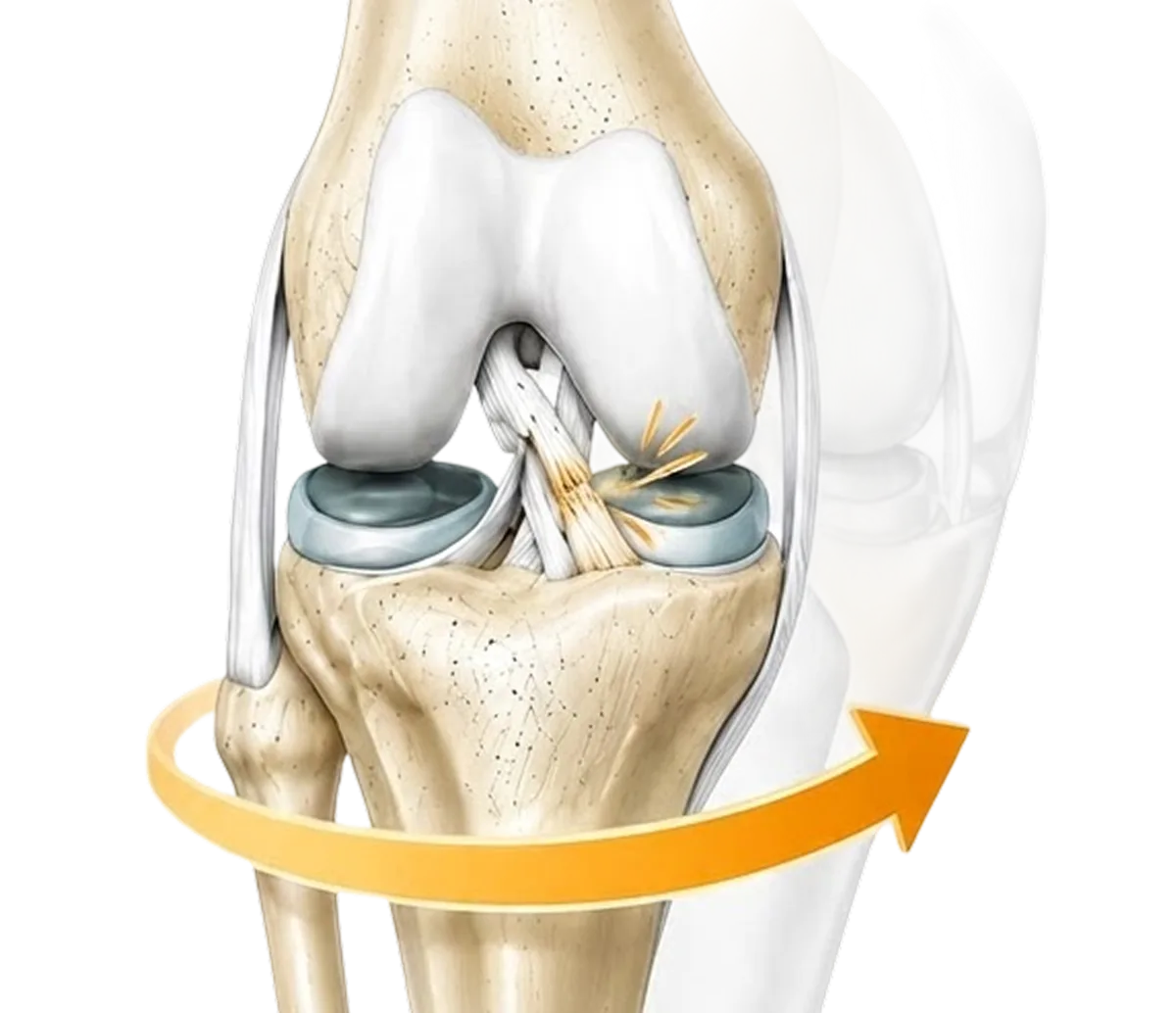 Knee anatomy showing a torn anterior cruciate ligament with a rotational arrow around the joint, illustrating the non-contact pivot mechanism of ACL injury