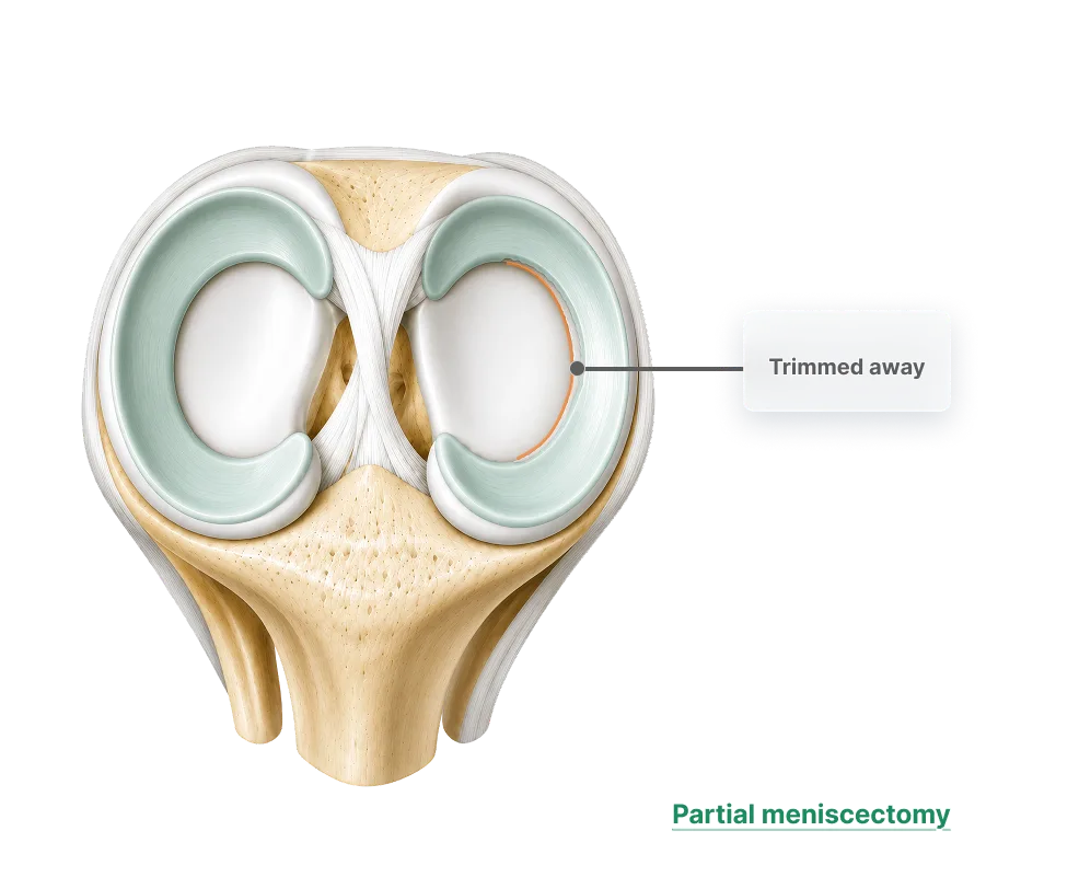 Front view of the knee showing a partial meniscectomy, where the damaged part of the meniscus has been trimmed away