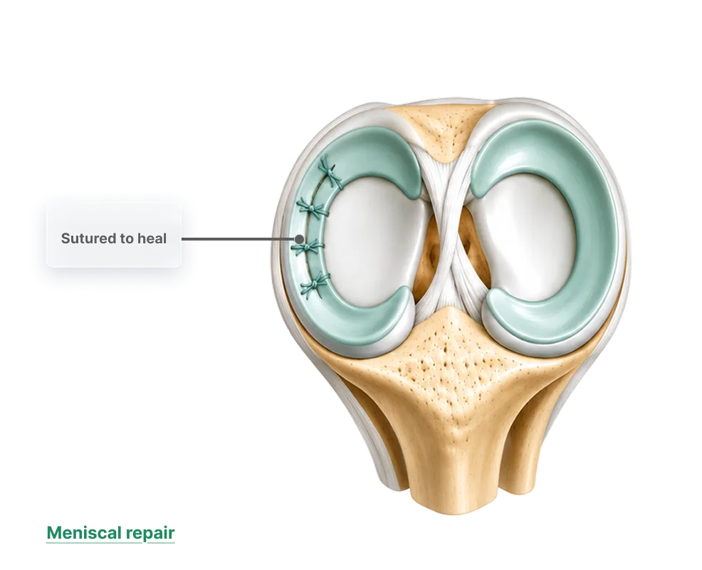 Front view of the knee showing a meniscal repair, where the torn meniscus has been stitched back together to heal